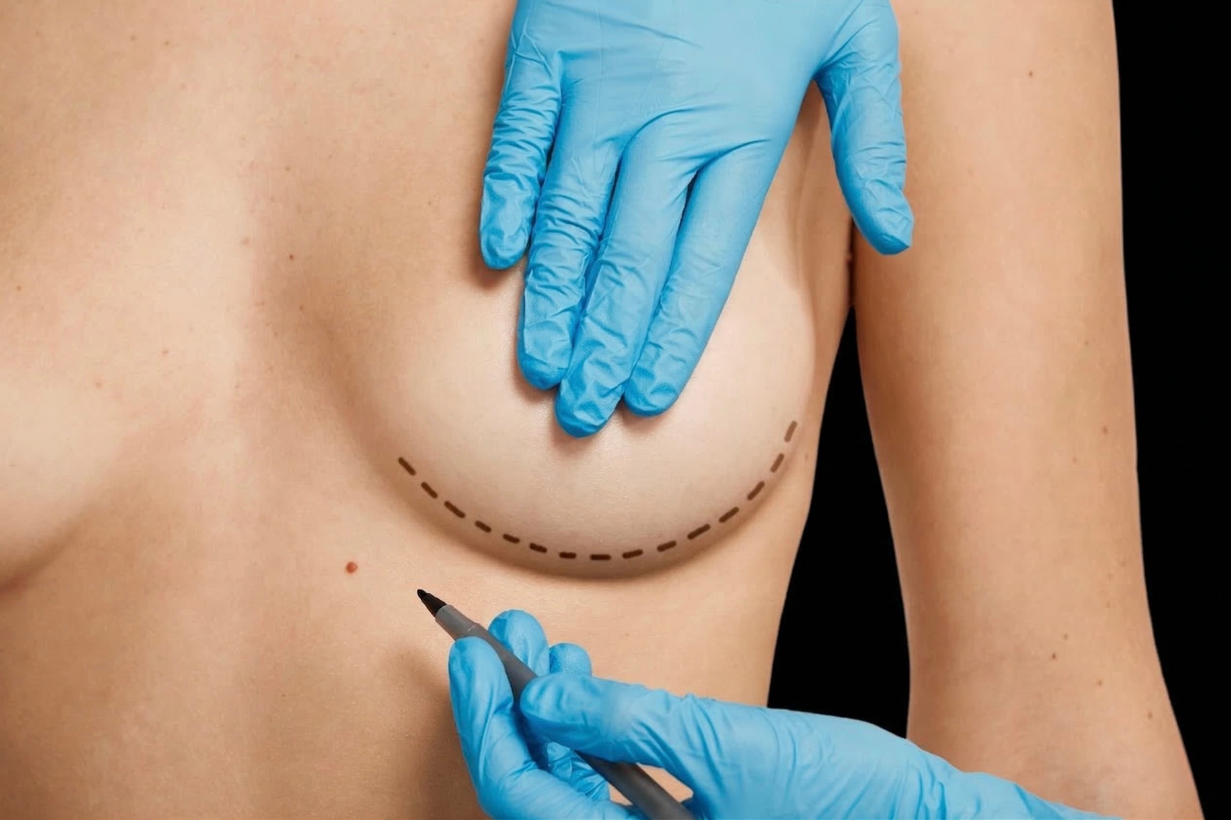 Mastoplastica Additiva